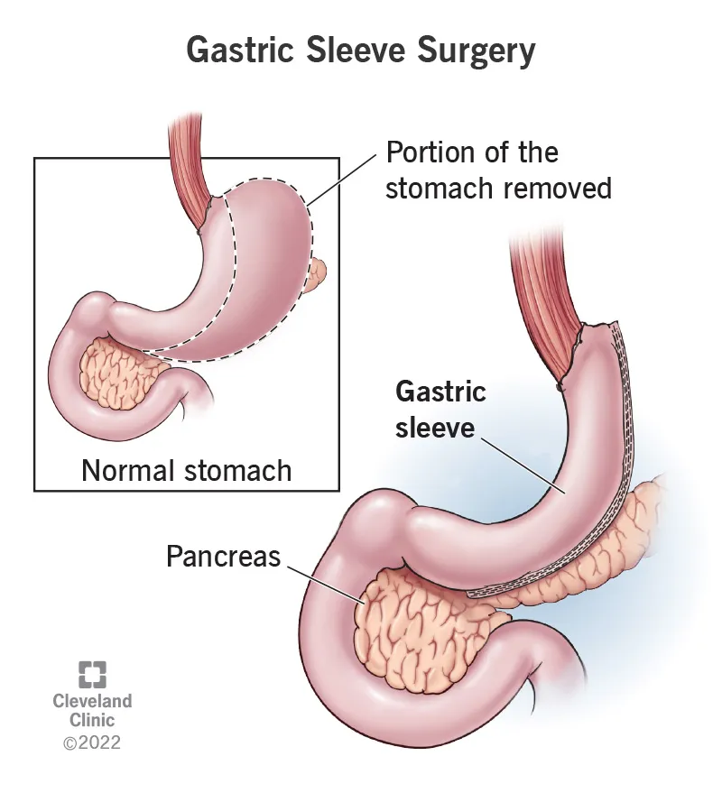 Gastric Sleeve Surgery Diagram