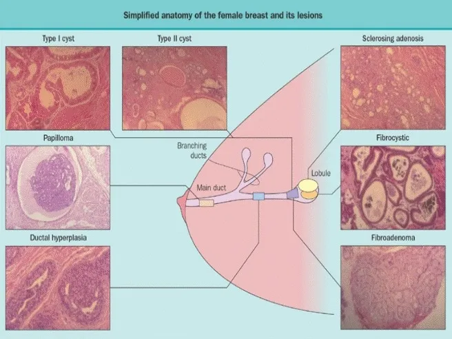 Histopathology of benign breast lesions