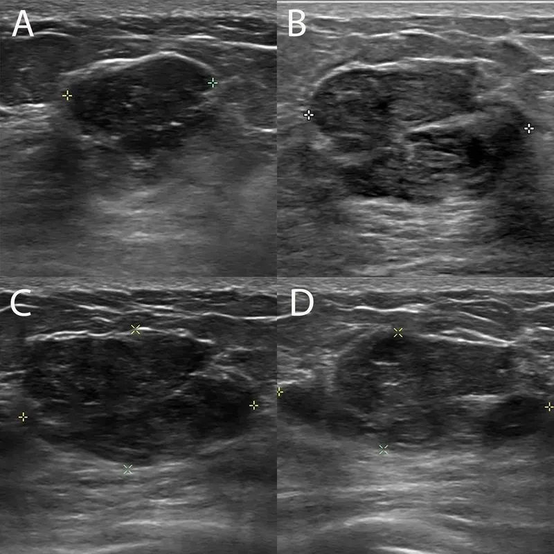 Ultrasound: Fibroadenoma vs Benign Phyllodes Tumor