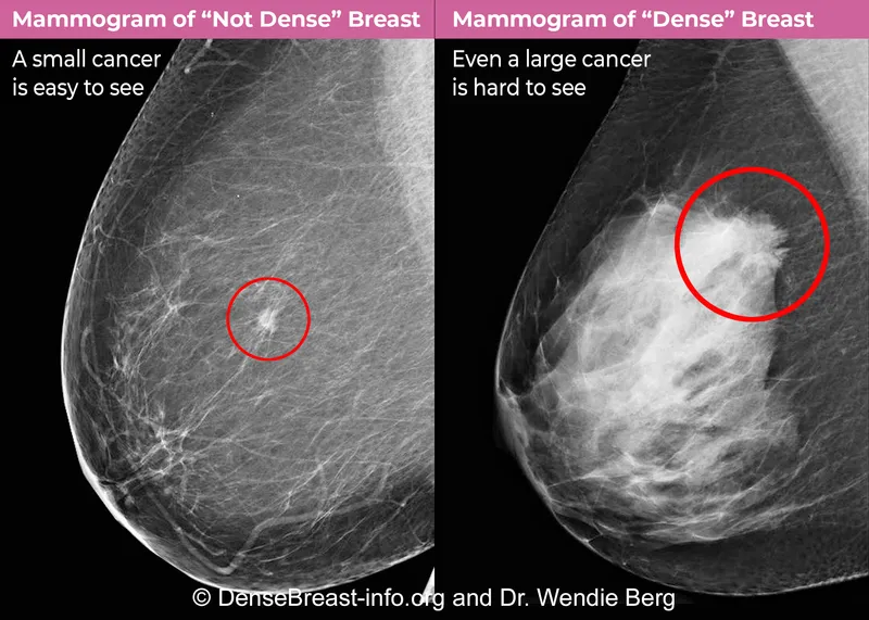 Mammogram: Dense vs Not Dense Breast Tissue