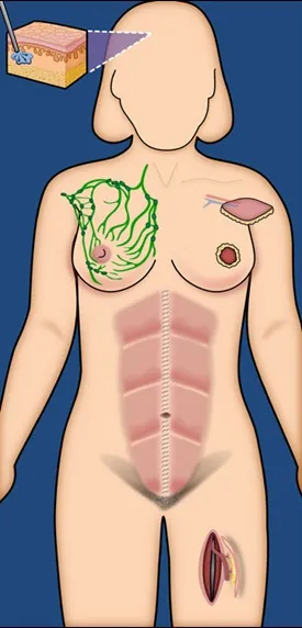 TRAM vs DIEP flap donor sites and muscle involvement