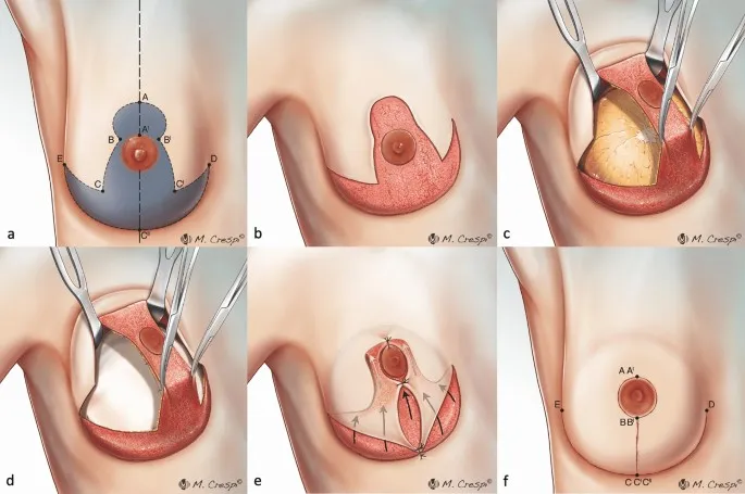 Nipple-areola complex reconstruction diagram