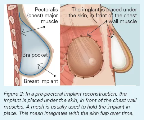 Pre-pectoral breast implant reconstruction diagram