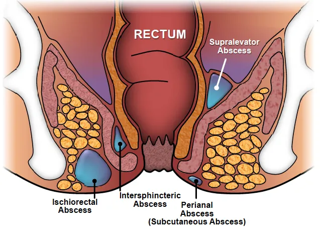 Anorectal Abscess Locations
