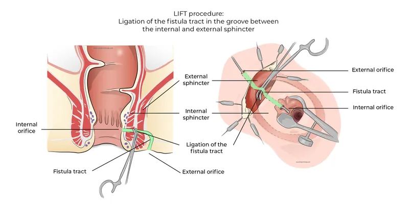 LIFT procedure for anal fistula