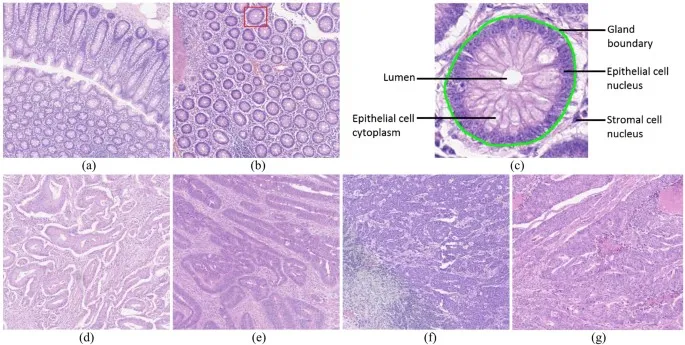Colorectal Adenocarcinoma Histology Micrographs