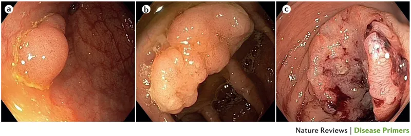 Colonoscopy views of colorectal adenocarcinoma