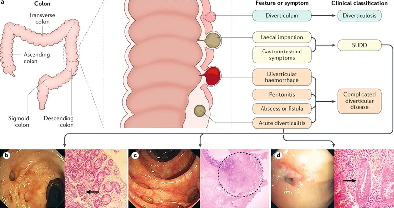 Diverticular disease: anatomy, symptoms, and complications