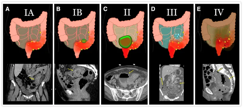 Hinchey Classification of Acute Diverticulitis