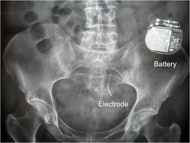 Sacral Nerve Stimulator Device and Lead Placement X-ray