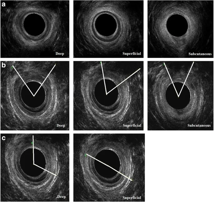 Endoanal ultrasound of anal sphincter integrity
