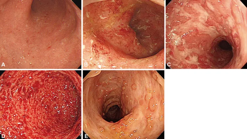 Endoscopic features: Ulcerative Colitis vs Crohn's