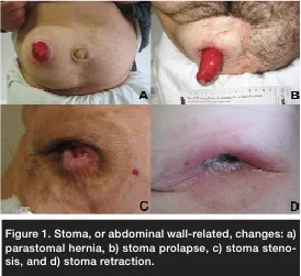 Stoma complications: hernia, prolapse, stenosis, retraction
