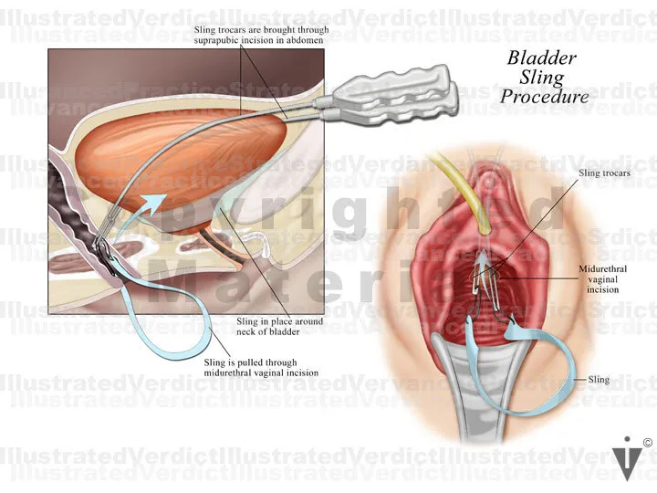 Mid-urethral sling procedure illustration