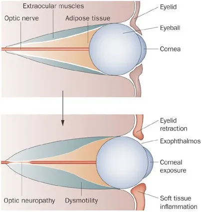 Graves' ophthalmopathy: normal vs affected eye