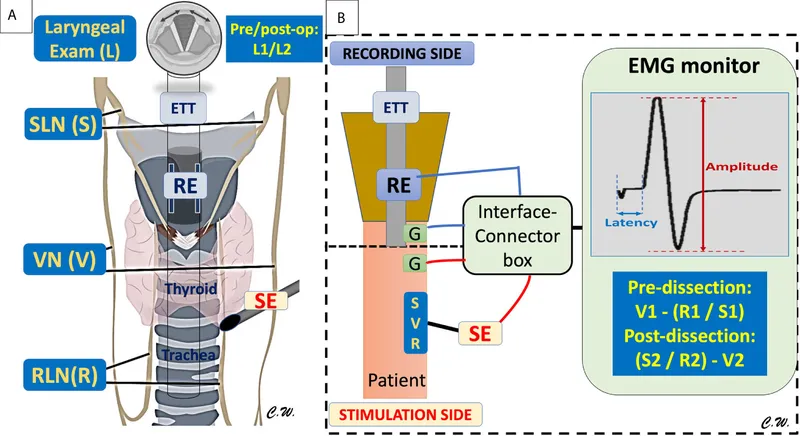 Intraoperative nerve monitoring setup