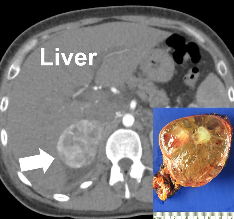 CT and gross pathology of adrenal pheochromocytoma