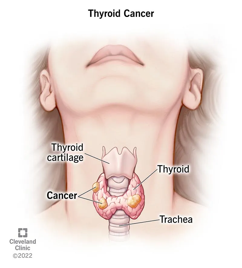 Thyroid Cancer Location Diagram