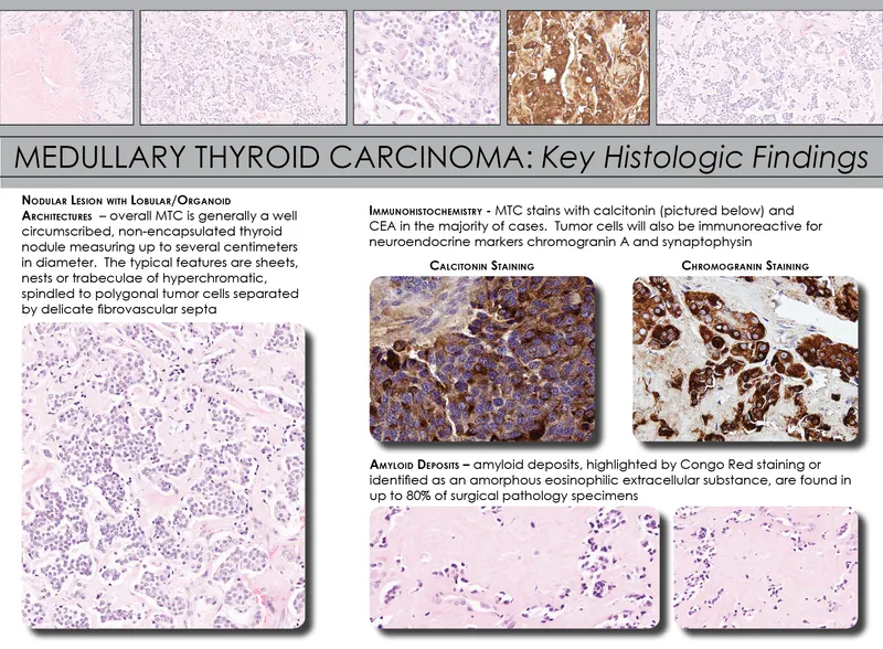 Medullary Thyroid Carcinoma: Key Histologic Findings