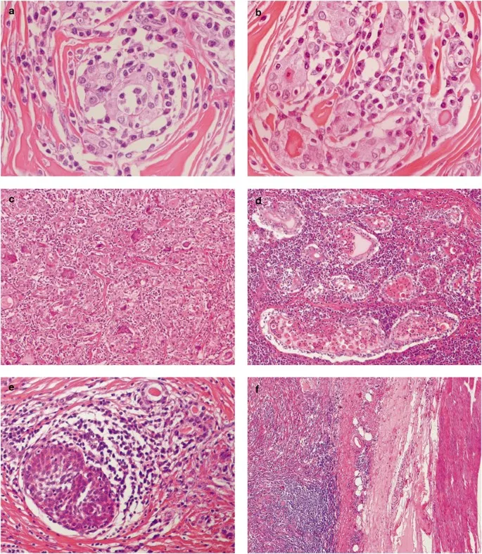 Riedel's thyroiditis histology