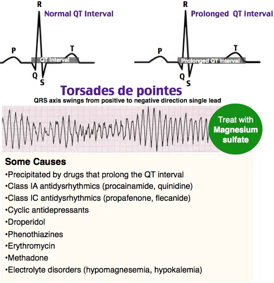 Torsades de Pointes EKG with causes and magnesium treatment
