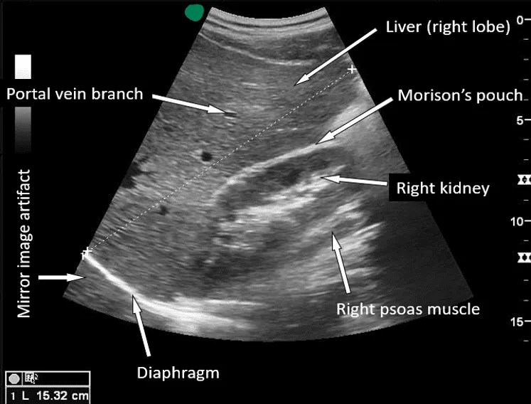 Ultrasound FAST scan: Free fluid in Morison's pouch