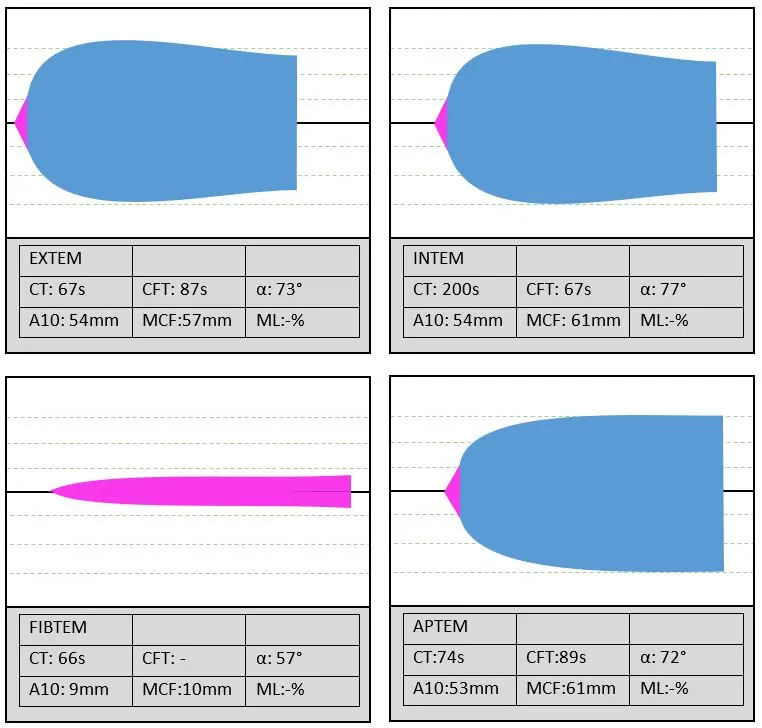 ROTEM tracings with CT, CFT, Alpha-angle, MCF, ML parameters