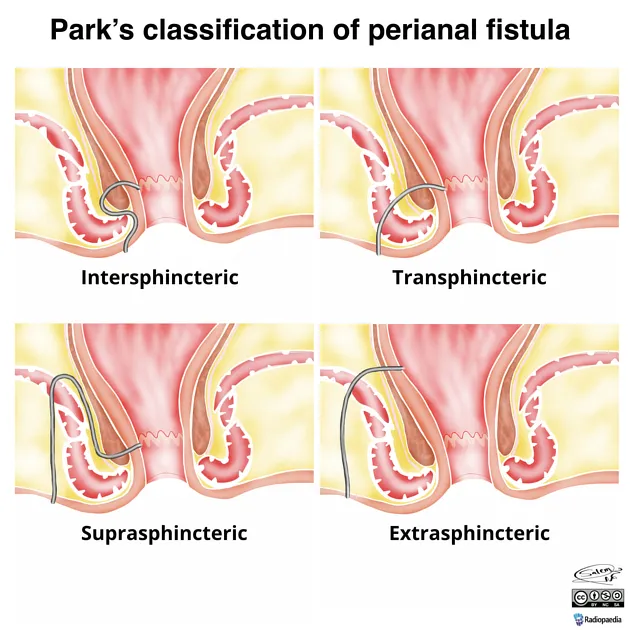 Parks classification of perianal fistula