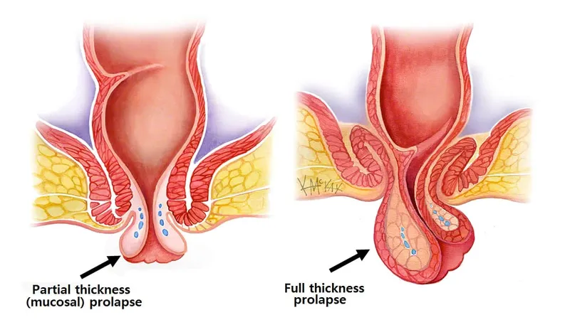 Mucosal vs Full-Thickness Rectal Prolapse
