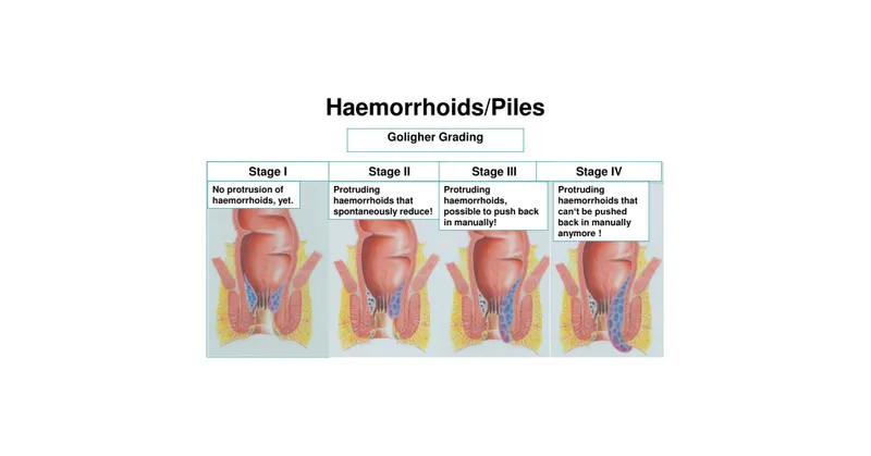 Goligher Grading of Hemorrhoids
