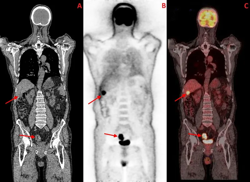 PET-CT showing colorectal cancer with liver metastasis