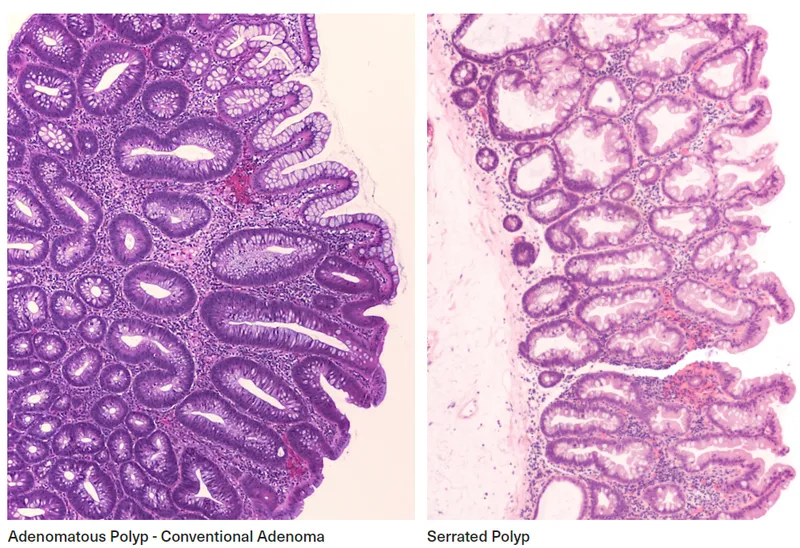 Histology: Adenomatous vs Serrated Polyps