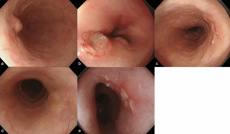 Endoscopic views of esophageal squamous cell carcinoma
