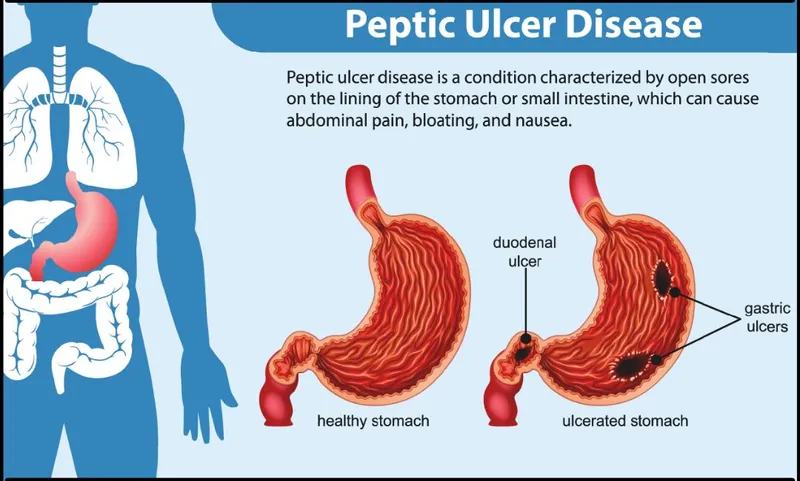 Peptic Ulcer Disease: Healthy vs. Ulcerated Stomach
