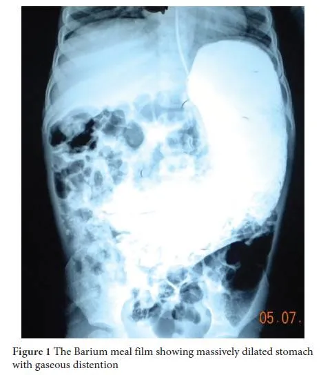 Barium meal X-ray: massively dilated stomach