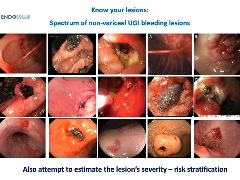 Endoscopic views of non-variceal UGI bleeding lesions