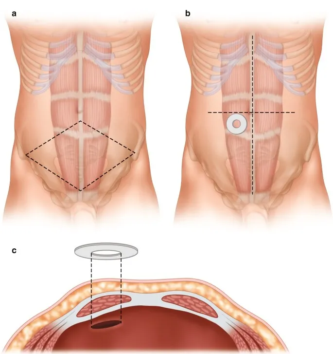 Optimal stoma siting and cross-section