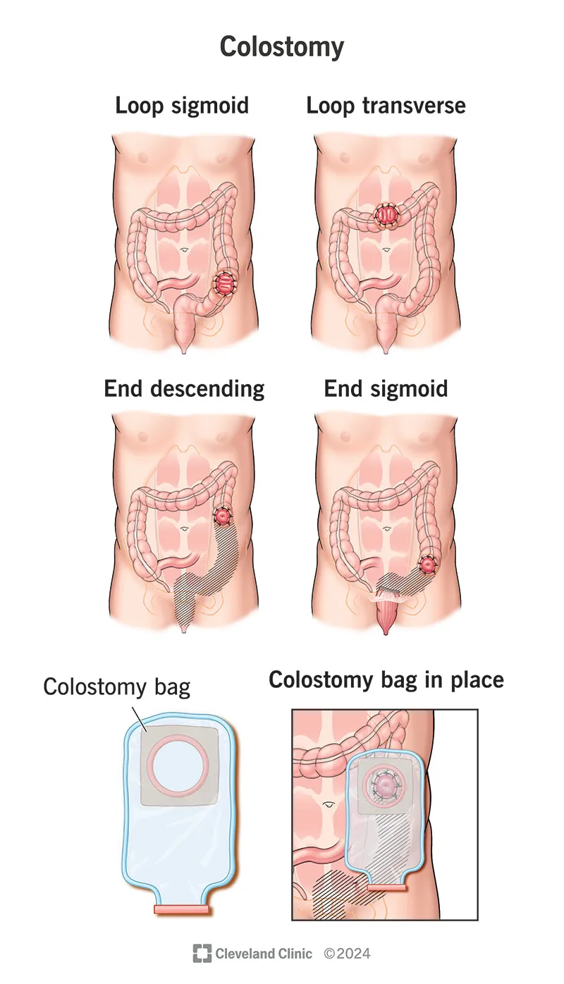 Colostomy types and bag placement