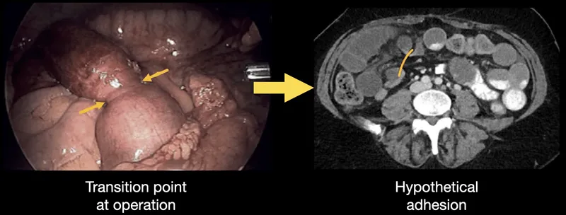 Small bowel obstruction: Laparoscopy and CT