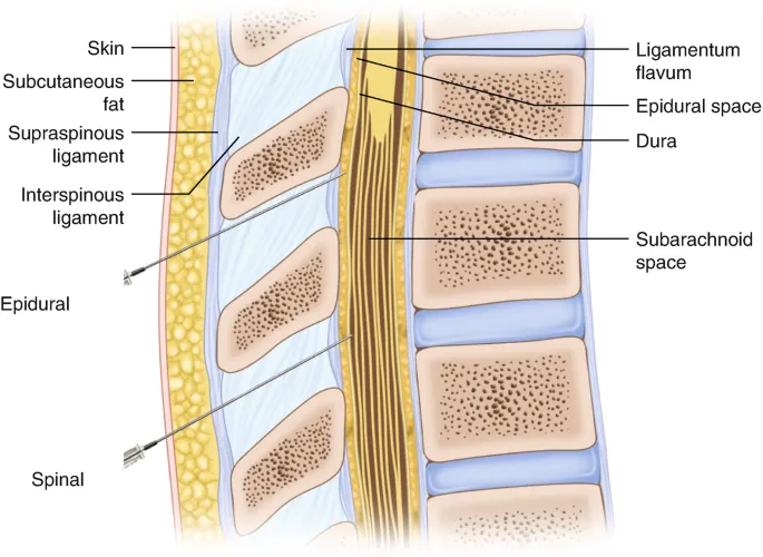 Epidural vs. Spinal Anesthesia Needle Placement