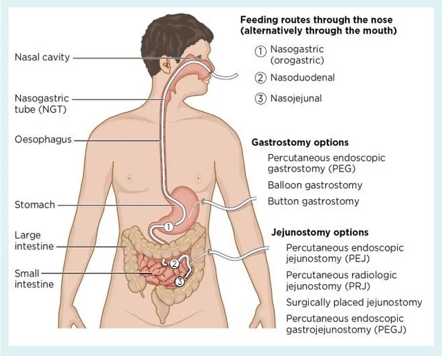 Enteral feeding tube access sites