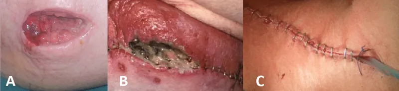 Surgical site infections with pus and wound dehiscence