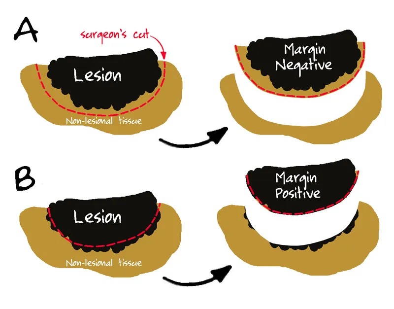 R0, R1, R2 Surgical Margins Diagram