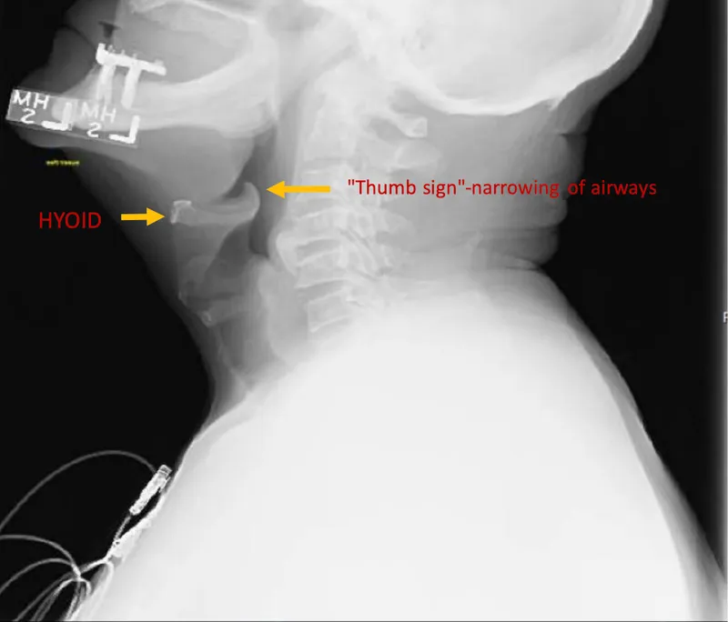 Lateral neck X-ray showing thumb sign in epiglottitis