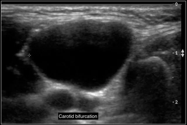 Ultrasound of cystic neck mass near carotid bifurcation