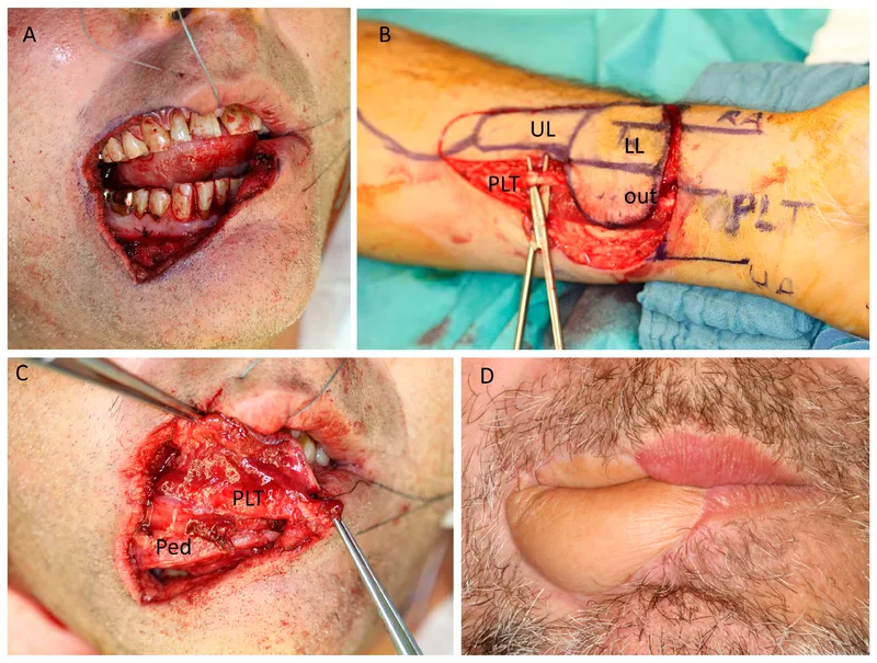 Radial Forearm Free Flap in Head and Neck Reconstruction