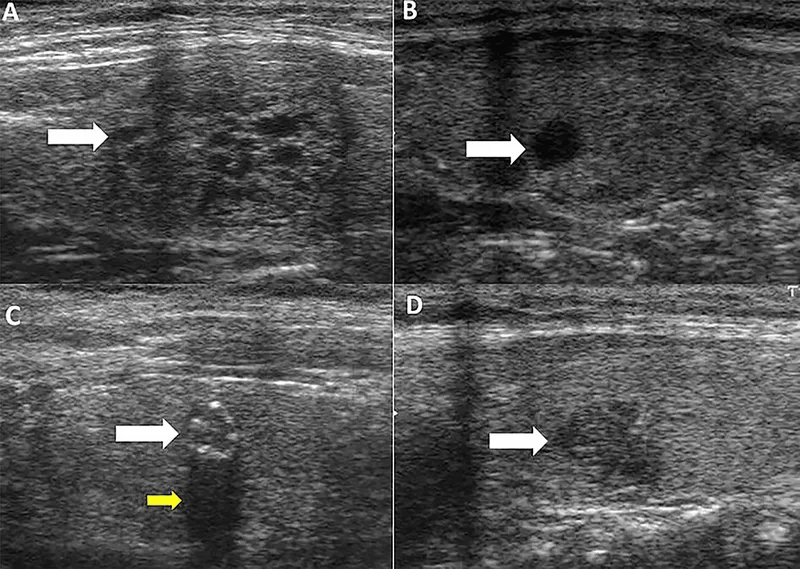 Ultrasound of thyroid nodule with halo sign