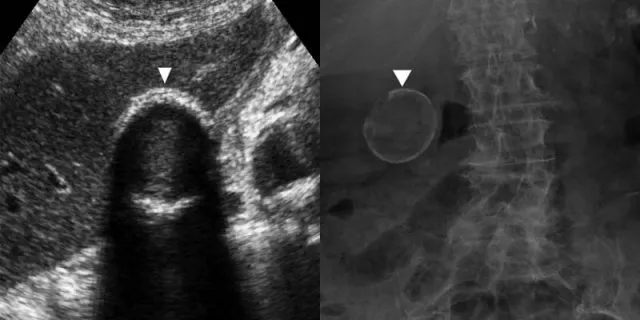 Ultrasound and X-ray of porcelain gallbladder
