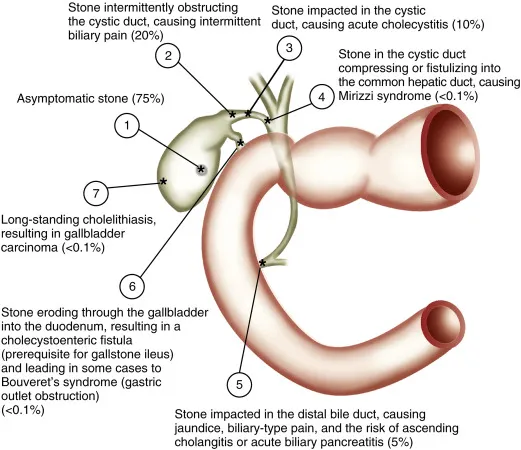 Gallstone complications diagram