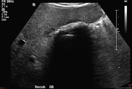Ultrasound of gallstones with acoustic shadowing